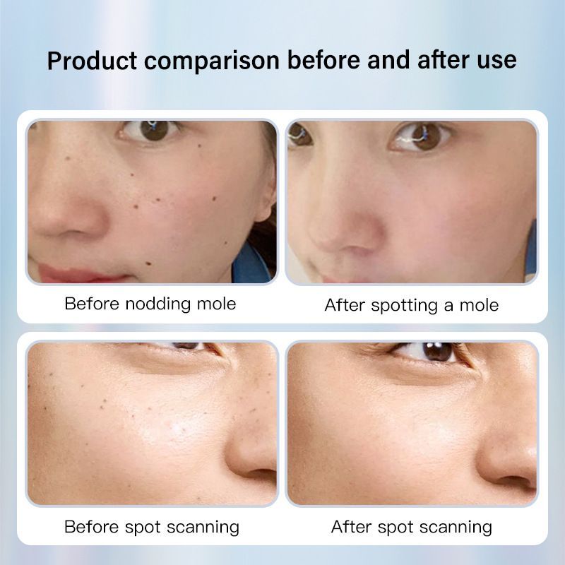 Dotting Mole Pen Nevus Removal Tool Spot Remover Red Blue Light Therapy Beauty